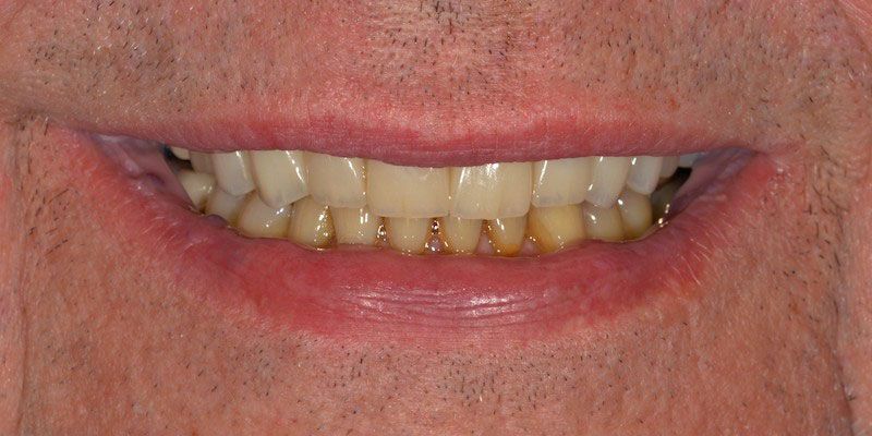 smile-gallery-4-after2